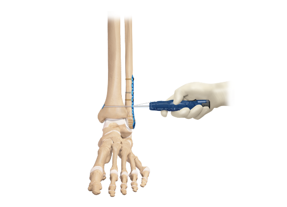 Arthrex - Syndesmosis TightRope XP Buttress Plate Implant System